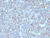 Formalin-fixed, paraffin-embedded human Ewing's Sarcoma stained with CD99 Monoclonal Antibody (SPM596).