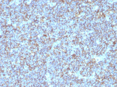 Formalin-fixed, paraffin-embedded human Ewing's Sarcoma stained with CD99 Monoclonal Antibody (SPM596).
