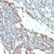 Formalin-fixed, paraffin-embedded human Ewing's sarcoma stained with CD99 Monoclonal Antibody (12E7+MIC2/877).