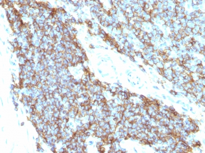 Formalin-fixed, paraffin-embedded human Ewing's sarcoma stained with CD99 Monoclonal Antibody (12E7+MIC2/877).