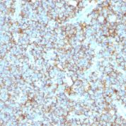 Formalin-fixed, paraffin-embedded human Ewings Sarcoma stained with CD99 Recombinant Rabbit Monoclonal Antibody (MIC2/1495R).