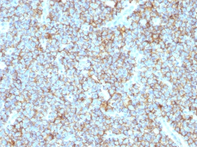 Formalin-fixed, paraffin-embedded human Ewings Sarcoma stained with CD99 Recombinant Rabbit Monoclonal Antibody (MIC2/1495R).