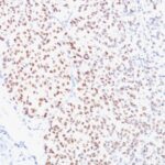 Formalin-fixed, paraffin-embedded human Melanoma stained with MITF Monoclonal Antibody (D5).