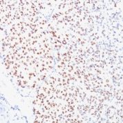 Formalin-fixed, paraffin-embedded human Melanoma stained with MITF Monoclonal Antibody (D5).