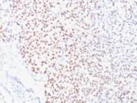 Formalin-fixed, paraffin-embedded human Melanoma stained with MITF Monoclonal Antibody (D5).