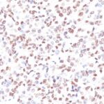 Formalin-fixed, paraffin-embedded human Melanoma stained with MITF Monoclonal Antibody (MITF/915).