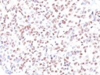 Formalin-fixed, paraffin-embedded human Melanoma stained with MITF Monoclonal Antibody (MITF/915).