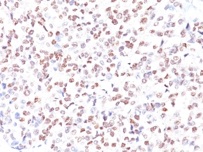 Formalin-fixed, paraffin-embedded human Melanoma stained with MITF Monoclonal Antibody (MITF/915).