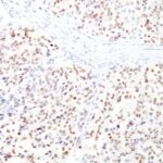 Formalin-fixed, paraffin-embedded human Melanoma stained with MITF Monoclonal Antibody (D5 + MITF/915).