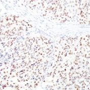Formalin-fixed, paraffin-embedded human Melanoma stained with MITF Monoclonal Antibody (D5 + MITF/915).