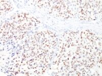 Formalin-fixed, paraffin-embedded human Melanoma stained with MITF Monoclonal Antibody (D5 + MITF/915).