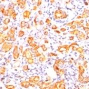 Formalin-fixed, paraffin-embedded human Breast Carcinoma stained with EMA Monoclonal Antibody (GP1.4).