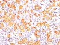 Formalin-fixed, paraffin-embedded human Breast Carcinoma stained with EMA Monoclonal Antibody (GP1.4).