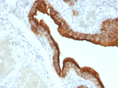 Formalin-fixed, paraffin-embedded human Ovarian Carcinoma stained with EMA Monoclonal Antibody (HMPV).