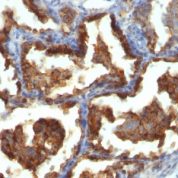 Formalin-fixed, paraffin-embedded human Breast Carcinoma stained with EMA Monoclonal Antibody (MUC1/955).