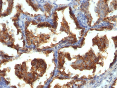 Formalin-fixed, paraffin-embedded human Breast Carcinoma stained with EMA Monoclonal Antibody (MUC1/955).