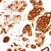 Formalin-fixed, paraffin-embedded human Ovarian Carcinoma stained with EMA Recombinant Mouse Monoclonal Antibody (MUC1/96).