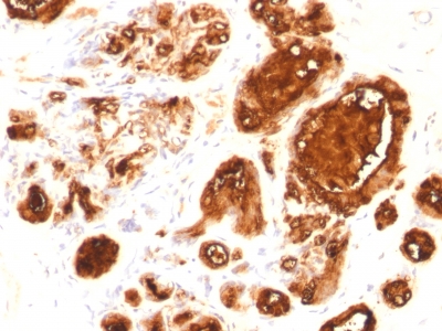 Formalin-fixed, paraffin-embedded human Ovarian Carcinoma stained with EMA Recombinant Mouse Monoclonal Antibody (MUC1/96).