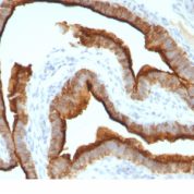 Formalin-fixed, paraffin-embedded human Breast Carcinoma stained with EMA Monoclonal Antibody (MUC1/967).
