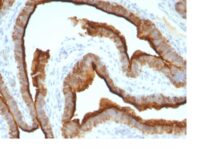 Formalin-fixed, paraffin-embedded human Breast Carcinoma stained with EMA Monoclonal Antibody (MUC1/967).