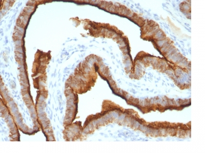 Formalin-fixed, paraffin-embedded human Breast Carcinoma stained with EMA Monoclonal Antibody (MUC1/967).