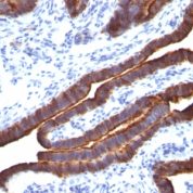 Formalin-fixed, paraffin-embedded human Colon Carcinoma stained with MUC-1 / EMA Monoclonal Antibody (MUC1/52).