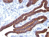 Formalin-fixed, paraffin-embedded human Colon Carcinoma stained with MUC-1 / EMA Monoclonal Antibody (MUC1/52).