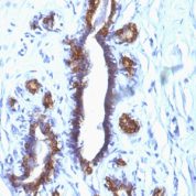 Formalin-fixed, paraffin-embedded human Breast Cancer stained with EMA Monoclonal Antibody (SPM132).