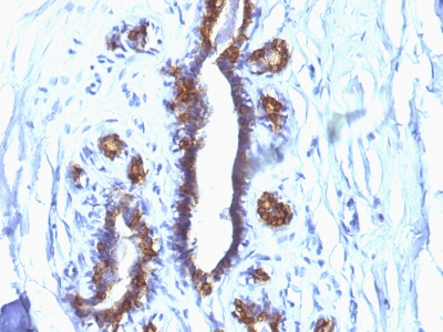 Formalin-fixed, paraffin-embedded human Breast Cancer stained with EMA Monoclonal Antibody (SPM132).