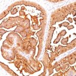 Formalin-fixed, paraffin-embedded human Breast Carcinoma stained with MUC-1 / EMA Monoclonal Antibody (E29).