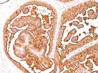 Formalin-fixed, paraffin-embedded human Breast Carcinoma stained with MUC-1 / EMA Monoclonal Antibody (E29).