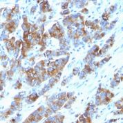 Formalin-fixed, paraffin-embedded human Breast Carcinoma stained with MUC-1 / EMA Monoclonal Antibody (SPM533).