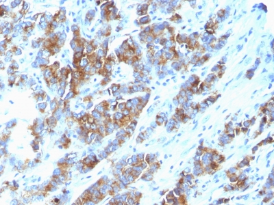 Formalin-fixed, paraffin-embedded human Breast Carcinoma stained with MUC-1 / EMA Monoclonal Antibody (SPM533).