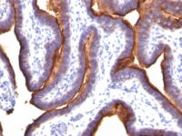 Formalin-fixed, paraffin-embedded human Colon Carcinoma stained with MUC1 / EMA Monoclonal Antibody (MUC1/845).