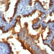 Formalin-fixed, paraffin-embedded human Breast Cancer stained with EMA Monoclonal Antibody (139H2).