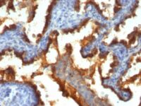 Formalin-fixed, paraffin-embedded human Breast Cancer stained with EMA Monoclonal Antibody (139H2).