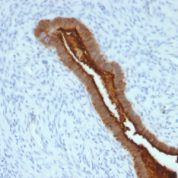 Formalin-fixed, paraffin-embedded human Endometrial Carcinoma stained with EMA Monoclonal Antibody (SPM492).
