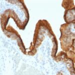 Formalin-fixed, paraffin-embedded human Ovarian Carcinoma stained with EMA Monoclonal Antibody (SPM493).