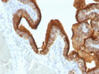 Formalin-fixed, paraffin-embedded human Ovarian Carcinoma stained with EMA Monoclonal Antibody (SPM493).