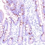 Formalin-fixed, paraffin-embedded human Colon Carcinoma stained with MUC2 Monoclonal Antibody (CCP58).