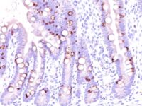 Formalin-fixed, paraffin-embedded human Colon Carcinoma stained with MUC2 Monoclonal Antibody (CCP58).