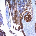 Formalin-fixed, paraffin-embedded human Colon Carcinoma stained with MUC2 Monoclonal Antibody (SPM296).