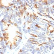 Formalin-fixed, paraffin-embedded human Colon Carcinoma stained with MUC2 Monoclonal Antibody (SPM513).
