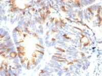 Formalin-fixed, paraffin-embedded human Colon Carcinoma stained with MUC2 Monoclonal Antibody (SPM513).