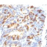 Formalin-fixed, paraffin-embedded human Colon Carcinoma stained with MUC2 Monoclonal Antibody (MLP/842).