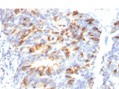 Formalin-fixed, paraffin-embedded human Colon Carcinoma stained with MUC2 Monoclonal Antibody (MLP/842).
