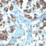 Formalin-fixed, paraffin-embedded human Gastric Carcinoma stained with MUC3 Monoclonal Antibody (M3.1).