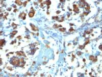 Formalin-fixed, paraffin-embedded human Gastric Carcinoma stained with MUC3 Monoclonal Antibody (M3.1).