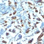 Formalin-fixed, paraffin-embedded human Gastric Carcinoma stained with MUC3 Monoclonal Antibody (SPM2).