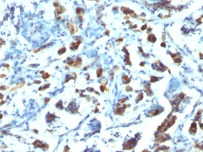 Formalin-fixed, paraffin-embedded human Gastric Carcinoma stained with MUC3 Monoclonal Antibody (SPM2).